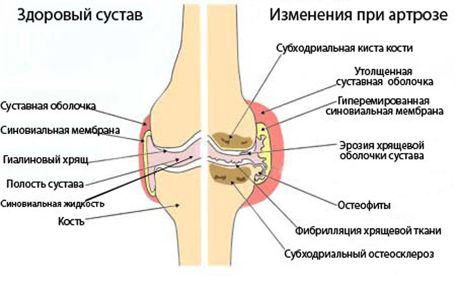 Схема лечения артроза